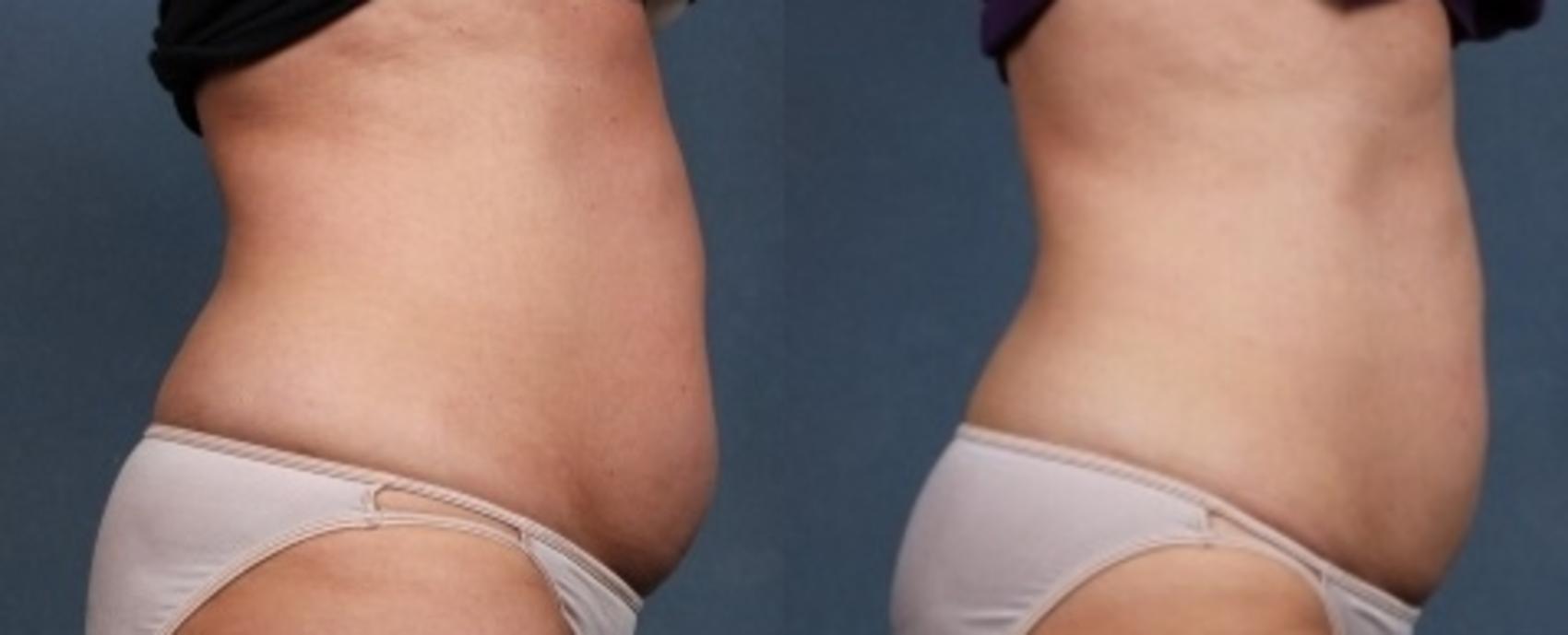 Before & After CoolSculpting Case 667 Right Side View in Louisville & Lexington, KY