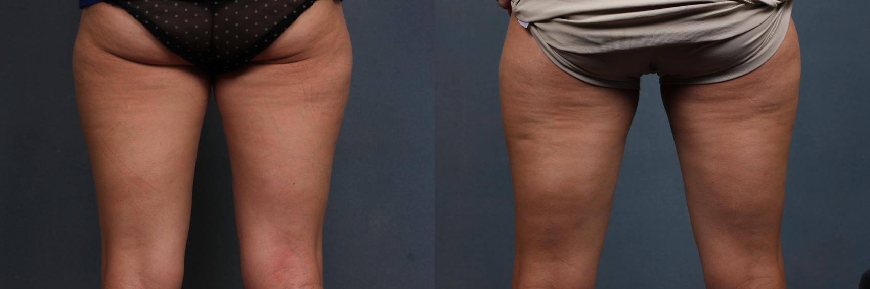 Before & After CoolSculpting Case 668 Back View in Louisville & Lexington, KY