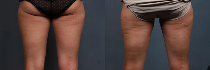 Before & After CoolSculpting Case 668 Back View in Louisville, KY