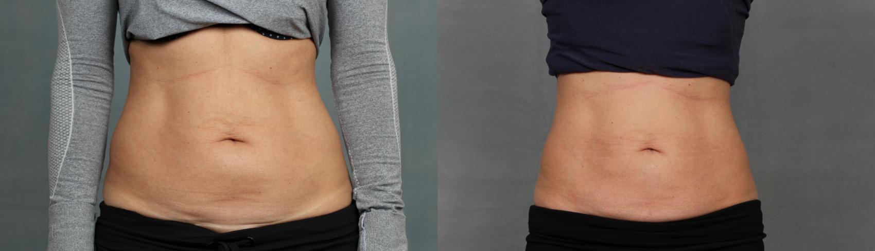 Before & After CoolSculpting Case 669 Front View in Louisville, KY