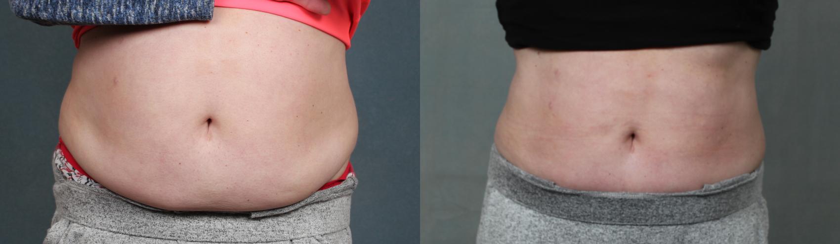 Before & After CoolSculpting Case 670 Front View in Louisville & Lexington, KY