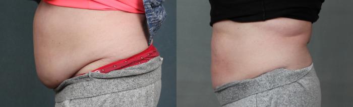 Before & After CoolSculpting Case 670 Left Side View in Louisville & Lexington, KY