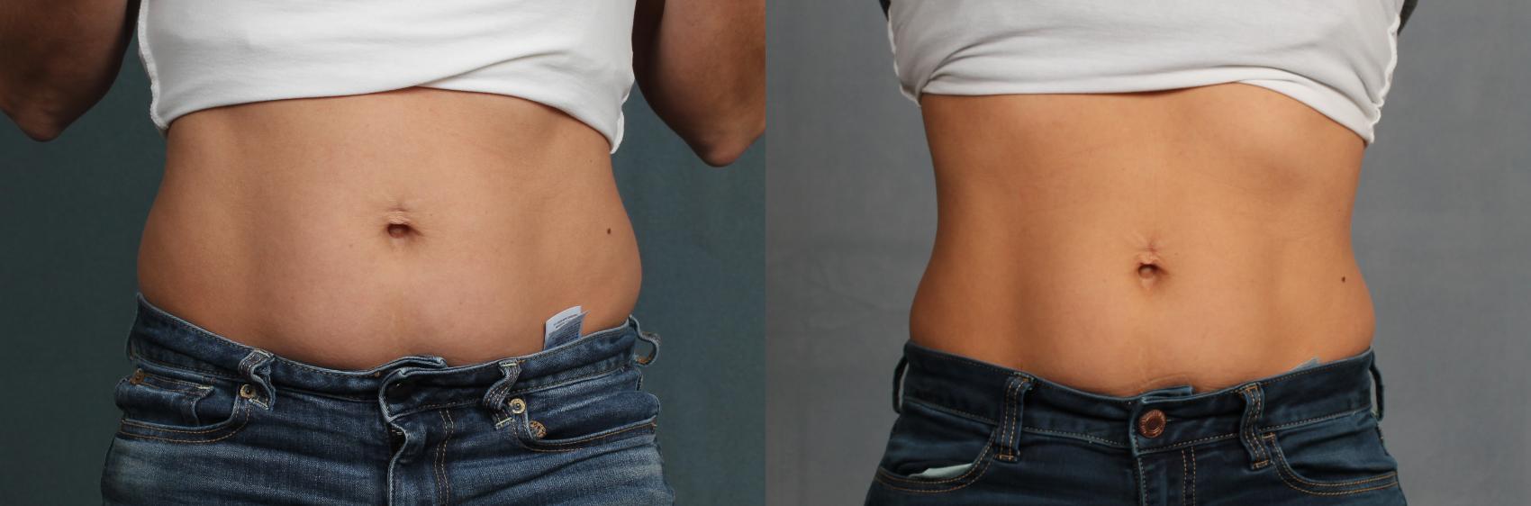 Before & After CoolSculpting Case 671 Front View in Louisville, KY
