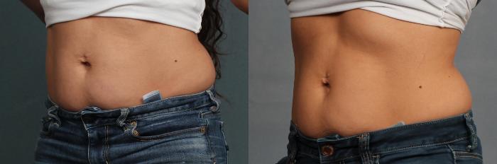 Before & After CoolSculpting Case 671 Right Oblique View in Louisville & Lexington, KY