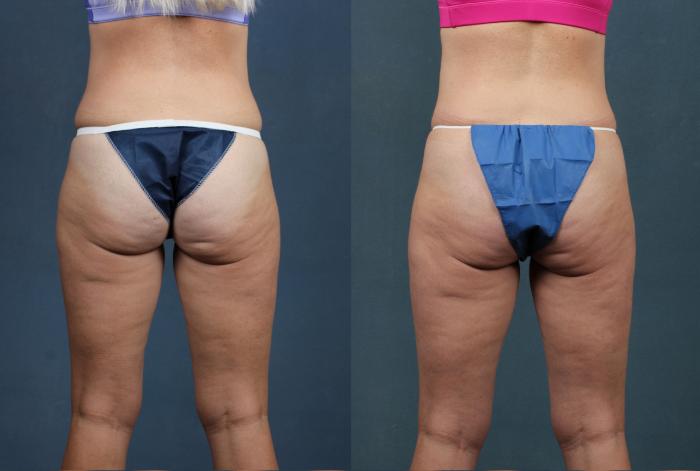 Cellulite Treatments Case 705 Before & After Back | Louisville, KY | CaloSpa® Rejuvenation Center