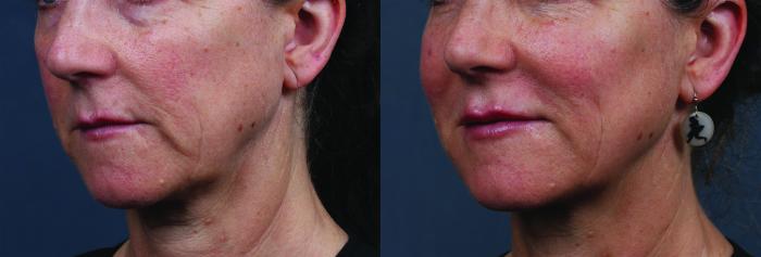 Dermal Fillers Case 636 Before & After Left Oblique | Louisville, KY | CaloSpa® Rejuvenation Center