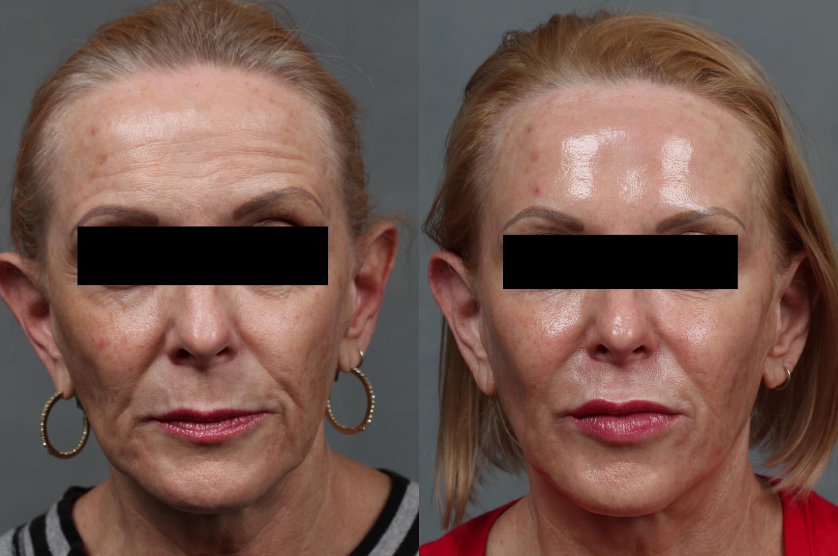 Before & After Dermal Fillers Case 637 Front View in Louisville & Lexington, KY