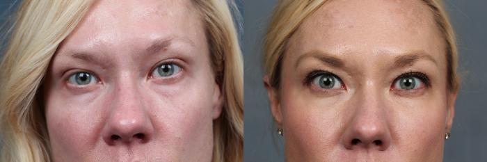 Before & After Dermal Fillers Case 638 Front View in Louisville & Lexington, KY