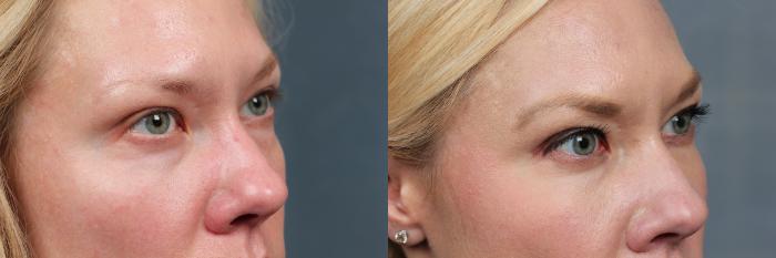 Before & After Dermal Fillers Case 638 Right Oblique View in Louisville & Lexington, KY