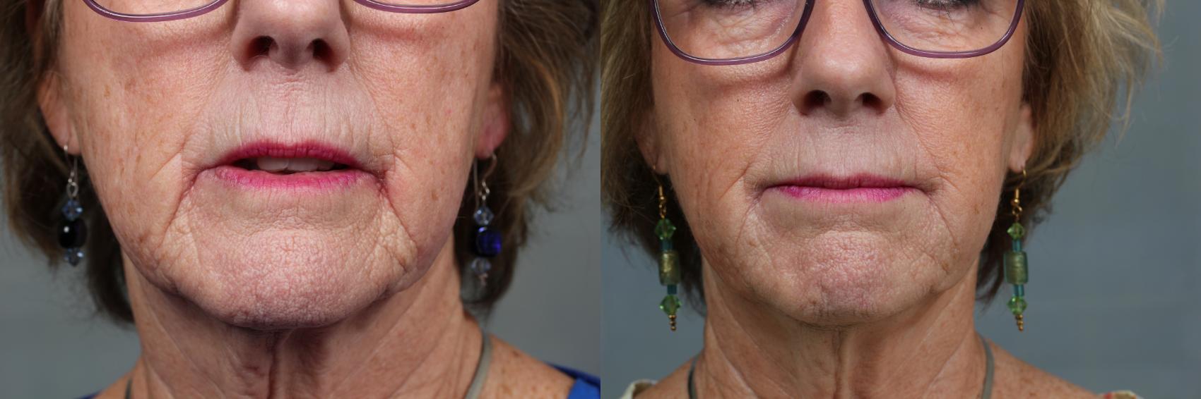 Before & After Dermal Fillers Case 639 Front View in Louisville, KY