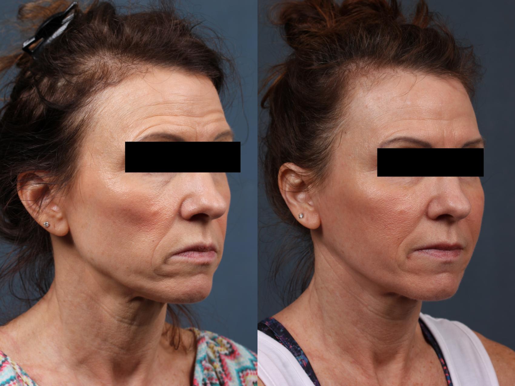 Before & After Dermal Fillers Case 641 Right Oblique View in Louisville, KY