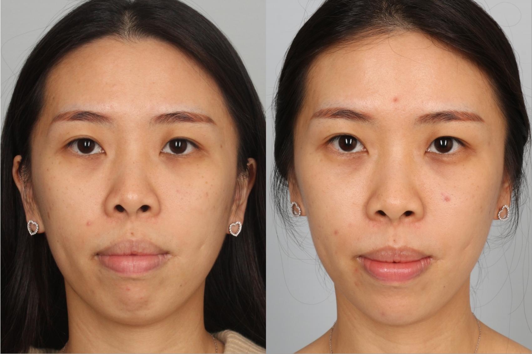 Dermal Fillers Case 768 Before & After Front | Louisville, KY | CaloSpa® Rejuvenation Center