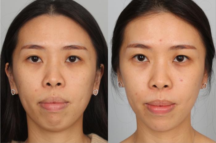 Dermal Fillers Case 768 Before & After Front | Louisville, KY | CaloSpa® Rejuvenation Center