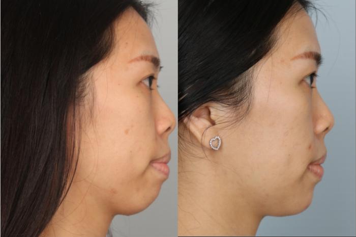 Dermal Fillers Case 768 Before & After Right Side | Louisville, KY | CaloSpa® Rejuvenation Center