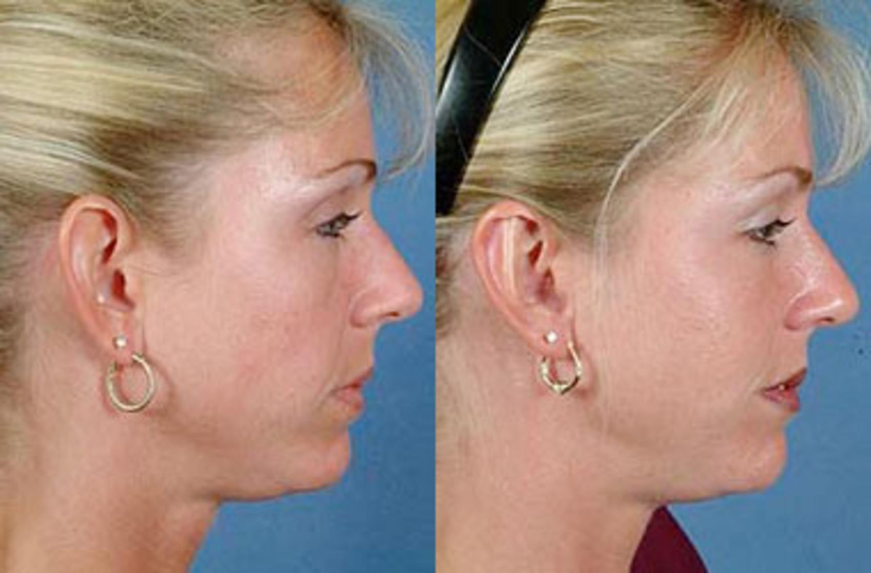 Ear Pinning Before And After Photos Patient 103 Louisville Ky Calospa® Rejuvenation Center 