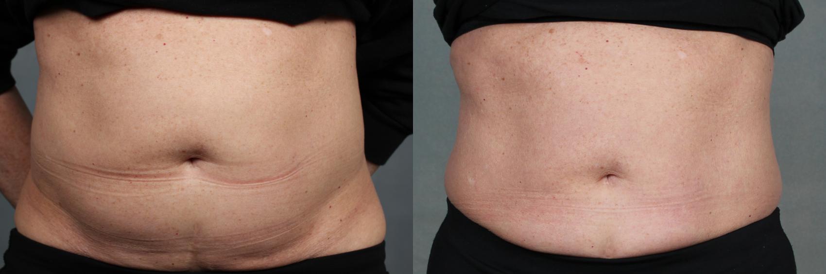 Before & After EMSculpt Case 651 Front View in Louisville, KY