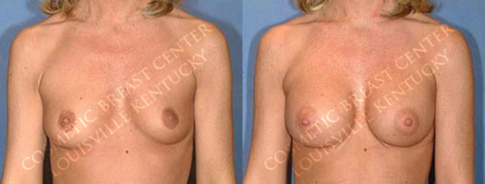 Before & After Enlargement - Saline Case 1 View #1 View in Louisville, KY