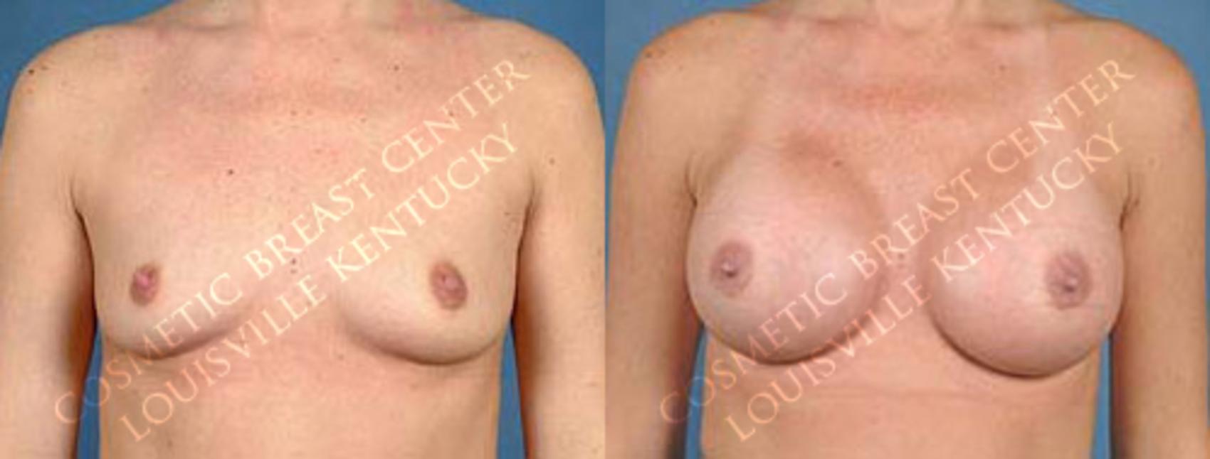 Before & After Enlargement - Saline Case 10 View #1 View in Louisville & Lexington, KY