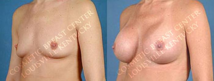 Before & After Enlargement - Saline Case 10 View #2 View in Louisville & Lexington, KY