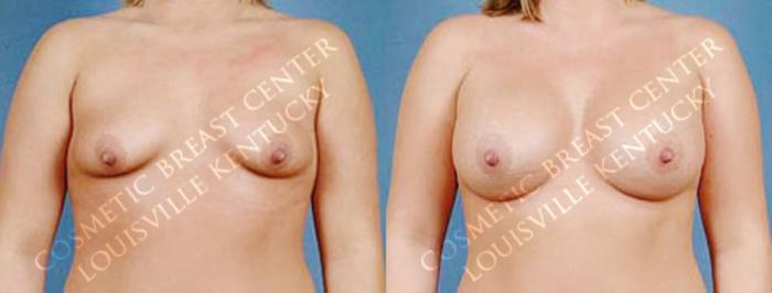 Before & After Enlargement - Saline Case 11 View #1 View in Louisville & Lexington, KY