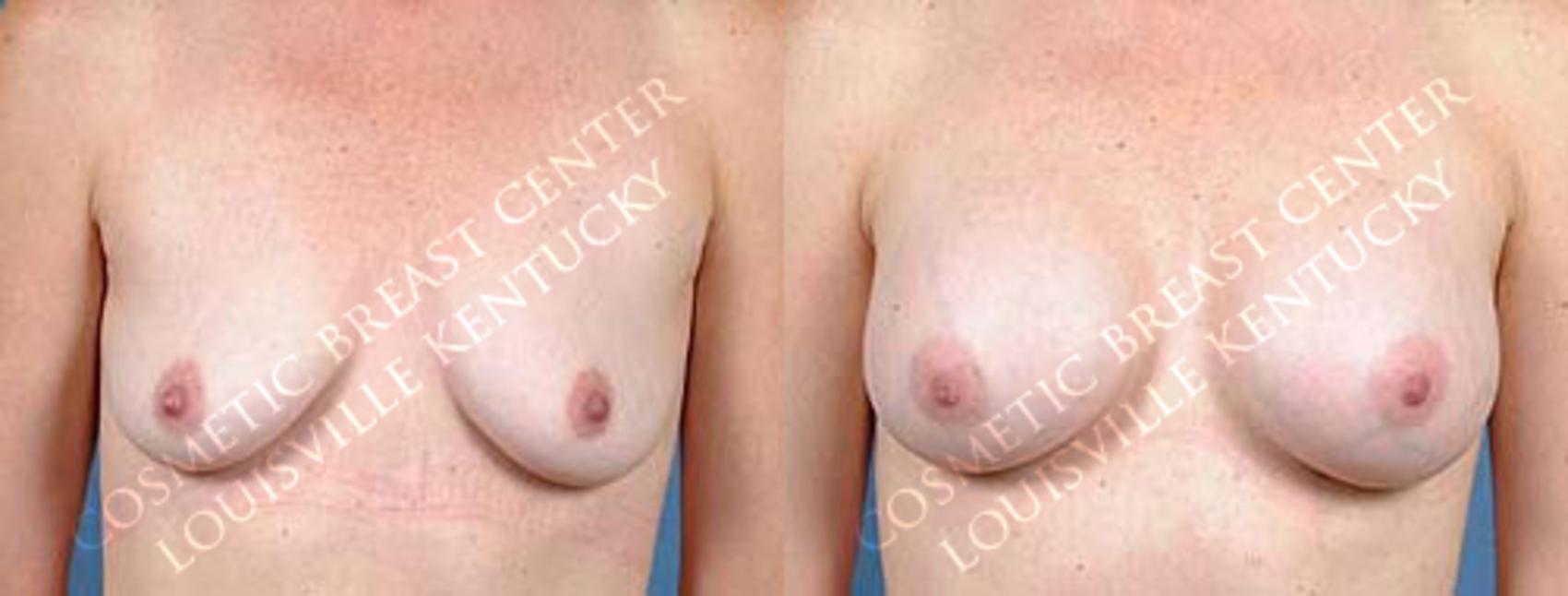 Before & After Enlargement - Saline Case 12 View #1 View in Louisville & Lexington, KY