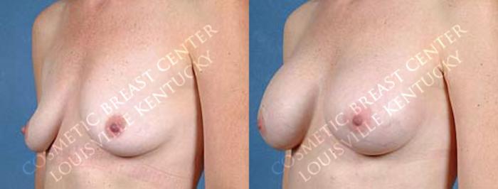 Enlargement - Saline Case 12 Before & After View #2 | Louisville, KY | CaloSpa® Rejuvenation Center