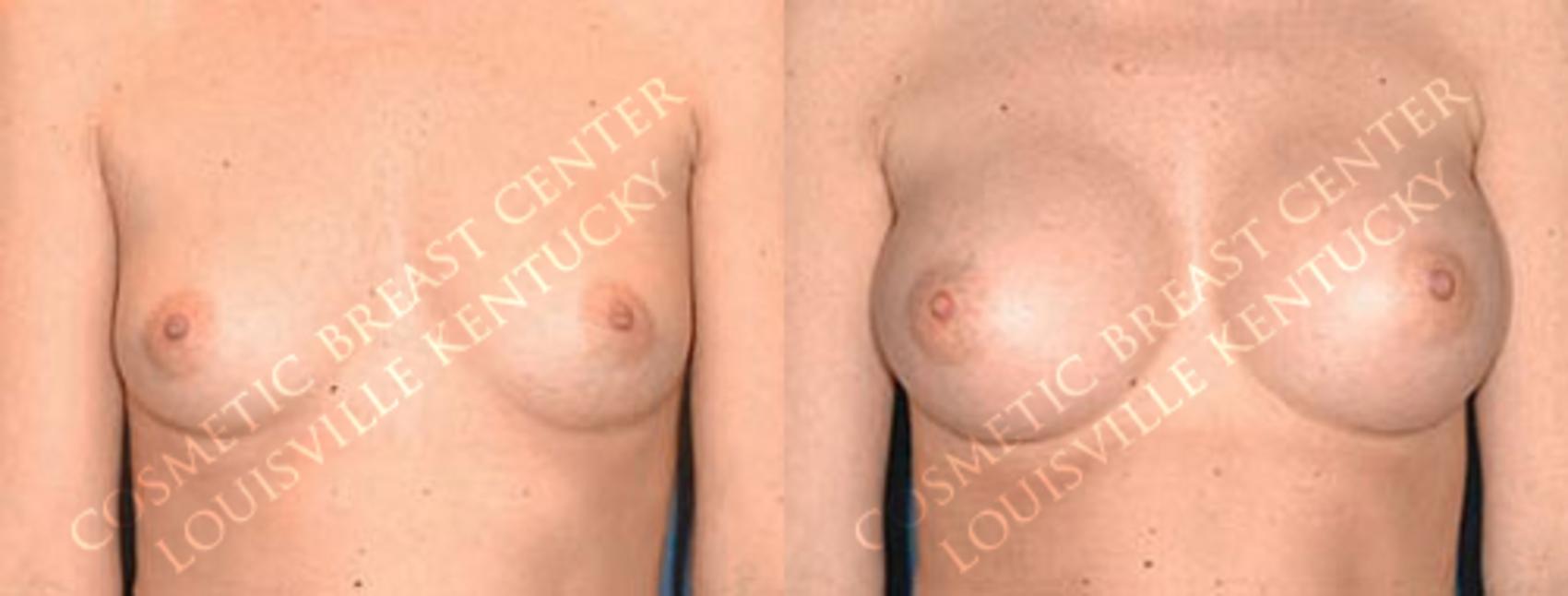 Before & After Enlargement - Saline Case 13 View #1 View in Louisville & Lexington, KY