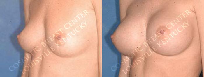 Before & After Enlargement - Saline Case 13 View #2 View in Louisville & Lexington, KY