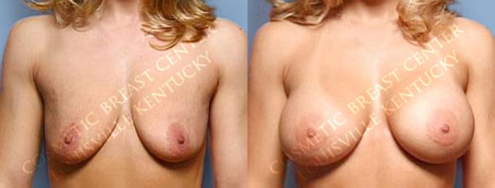 Before & After Enlargement - Saline Case 14 View #1 View in Louisville & Lexington, KY