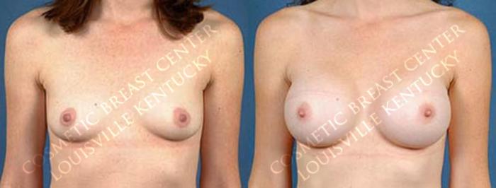 Before & After Enlargement - Saline Case 15 View #1 View in Louisville & Lexington, KY