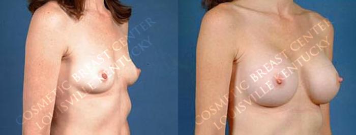 Before & After Enlargement - Saline Case 15 View #2 View in Louisville & Lexington, KY
