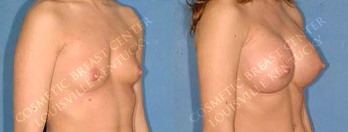 Before & After Enlargement - Saline Case 16 View #2 View in Louisville & Lexington, KY