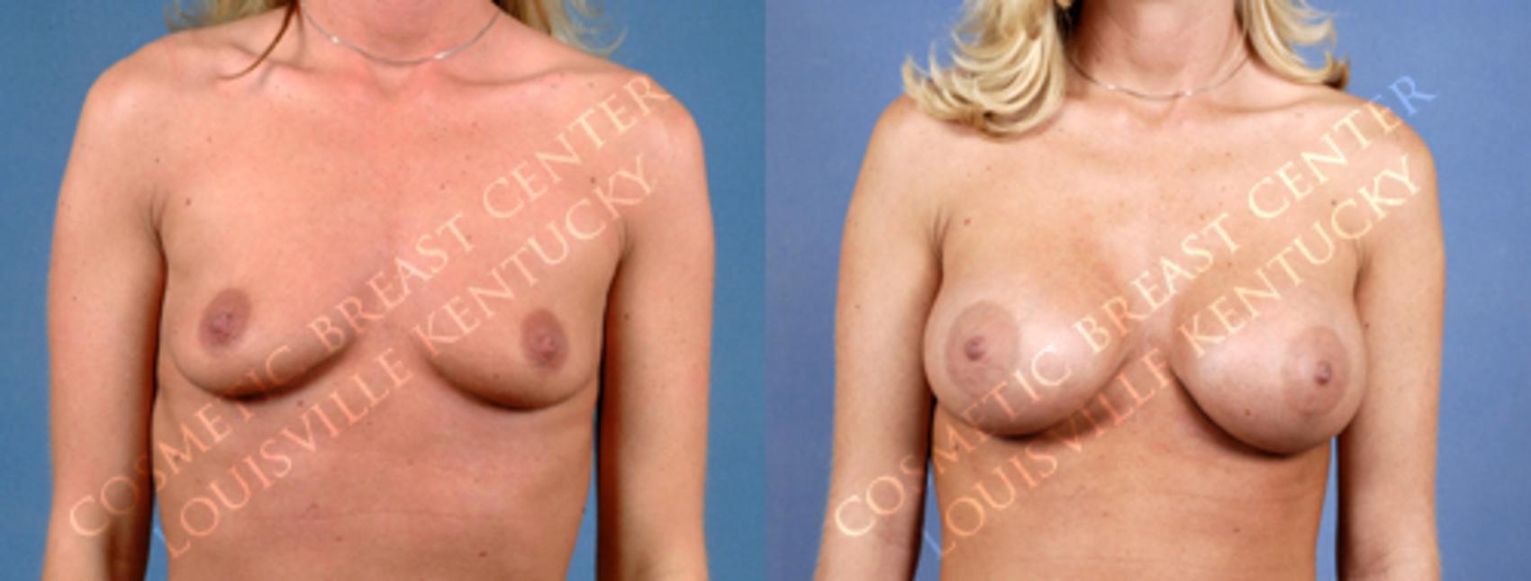 Before & After Enlargement - Saline Case 167 View #1 View in Louisville & Lexington, KY