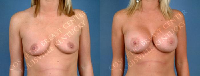 Before & After Enlargement - Saline Case 169 View #1 View in Louisville & Lexington, KY