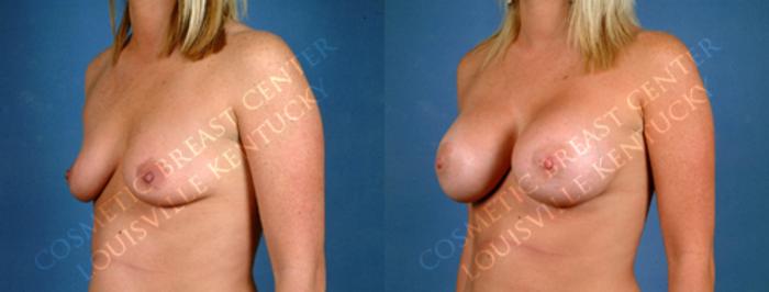 Before & After Enlargement - Saline Case 169 View #2 View in Louisville & Lexington, KY