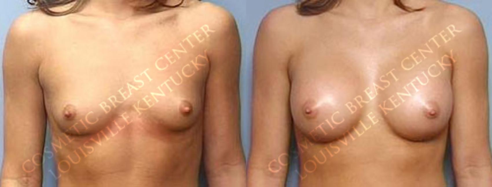 Before & After Enlargement - Saline Case 17 View #1 View in Louisville & Lexington, KY