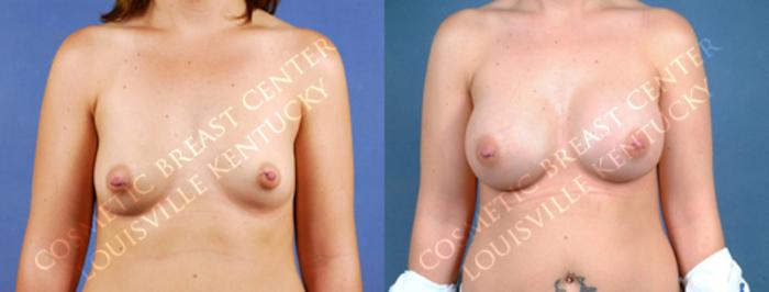 Before & After Enlargement - Saline Case 170 View #1 View in Louisville & Lexington, KY