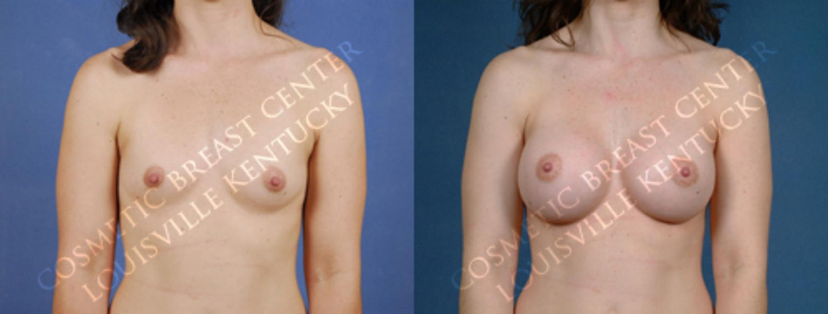 Before & After Enlargement - Saline Case 175 View #1 View in Louisville & Lexington, KY