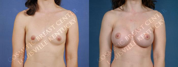 Before & After Enlargement - Saline Case 175 View #1 View in Louisville & Lexington, KY