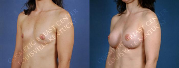 Before & After Enlargement - Saline Case 175 View #2 View in Louisville & Lexington, KY