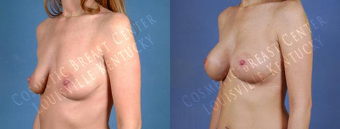 Before & After Enlargement - Saline Case 177 View #2 View in Louisville & Lexington, KY