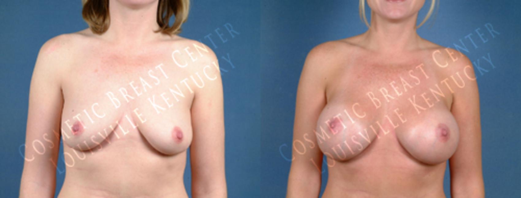 Before & After Enlargement - Saline Case 178 View #1 View in Louisville & Lexington, KY