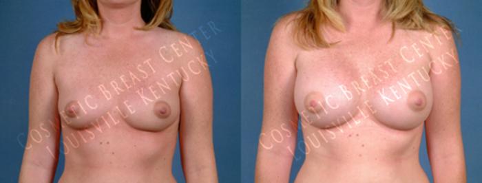 Before & After Enlargement - Saline Case 179 View #1 View in Louisville & Lexington, KY