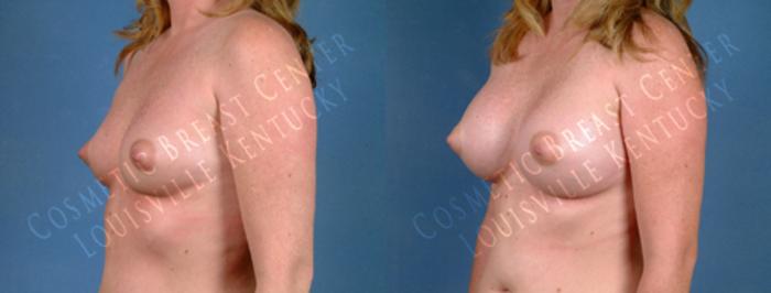 Before & After Enlargement - Saline Case 179 View #2 View in Louisville & Lexington, KY