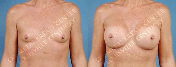 Before & After Enlargement - Saline Case 18 View #1 View in Louisville & Lexington, KY