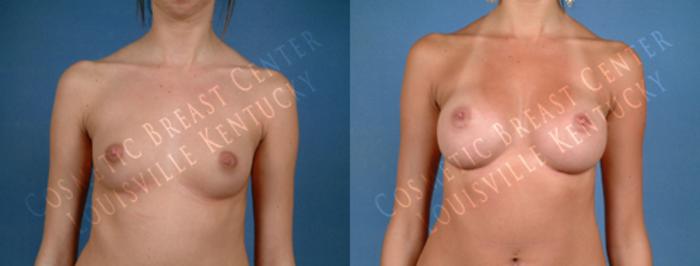Before & After Enlargement - Saline Case 180 View #1 View in Louisville & Lexington, KY