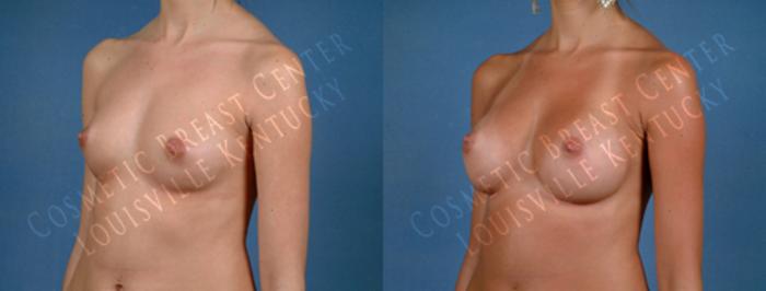 Before & After Enlargement - Saline Case 180 View #2 View in Louisville & Lexington, KY