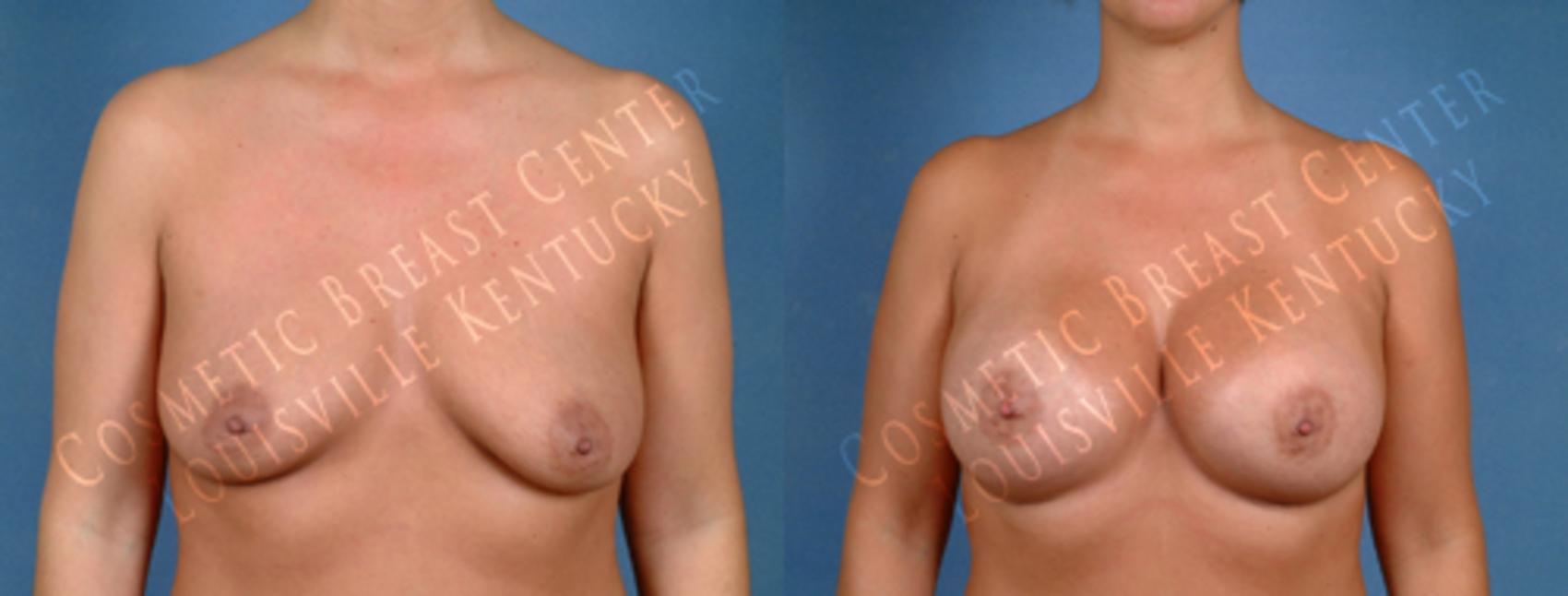 Before & After Enlargement - Saline Case 181 View #1 View in Louisville & Lexington, KY