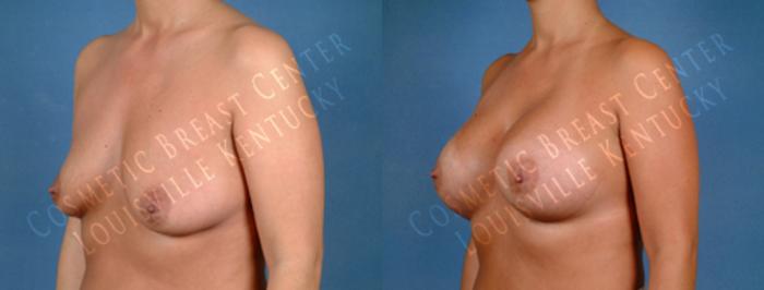 Before & After Enlargement - Saline Case 181 View #2 View in Louisville & Lexington, KY
