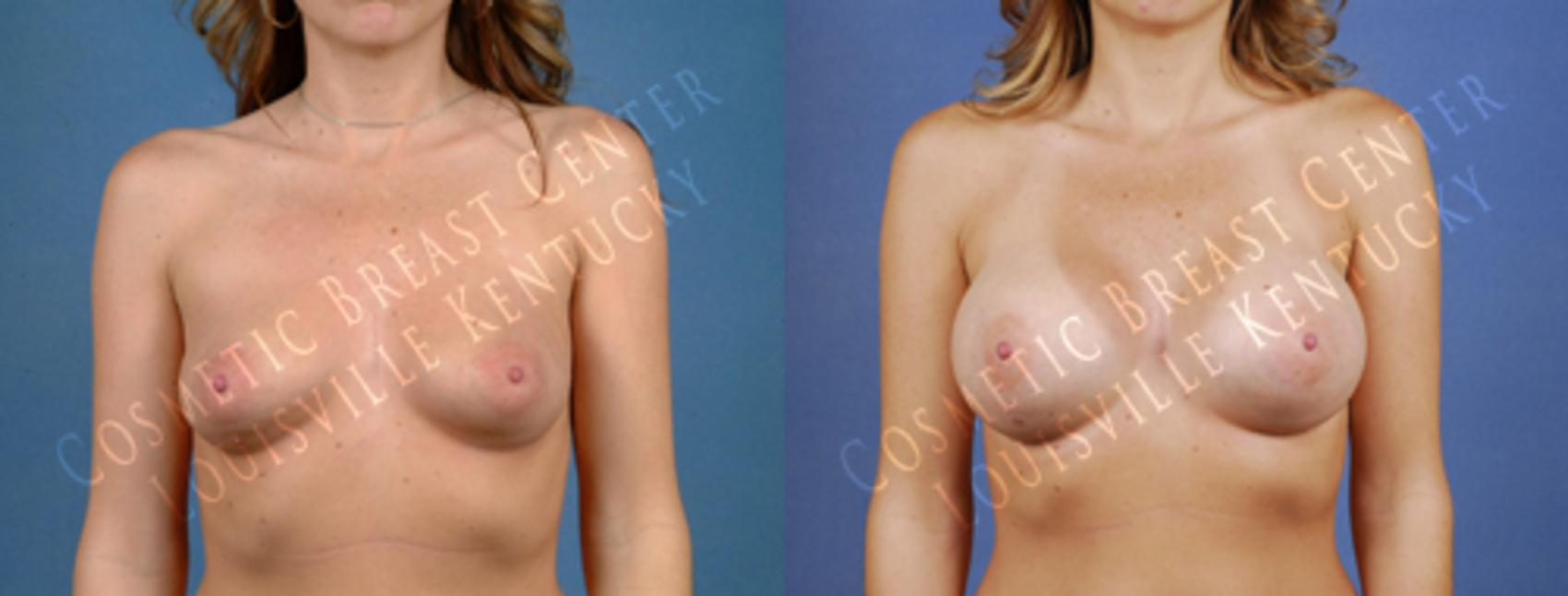 Before & After Enlargement - Saline Case 182 View #1 View in Louisville & Lexington, KY
